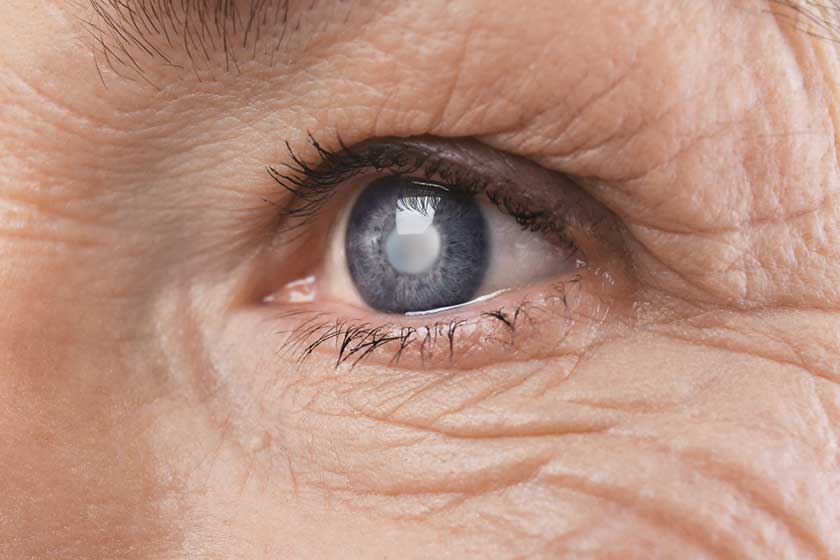 Cataract concept. Senior woman’s eye, closeup Cataract concept. Senior woman's eye, closeup